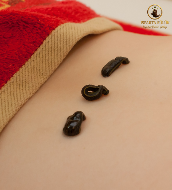 Canlı Sülük Nasıl Uygulanır Isparta Sülük Sağlıklı Yaşam Çiftliği